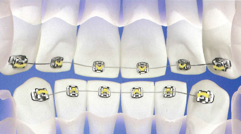 Illustration of MTM lingual braces on lower teeth